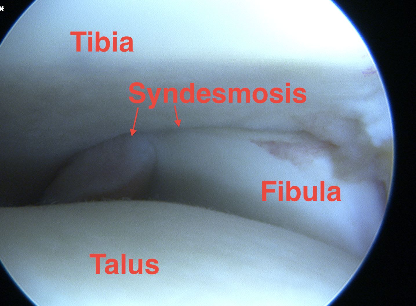 Ankle scope syndesmosis